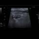 Acute diverticulitis on ultrasound: US - Ultrasound